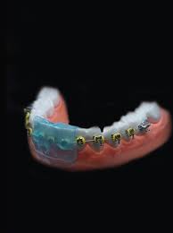 OmniGuard - Lip Protector - Silverstein Works